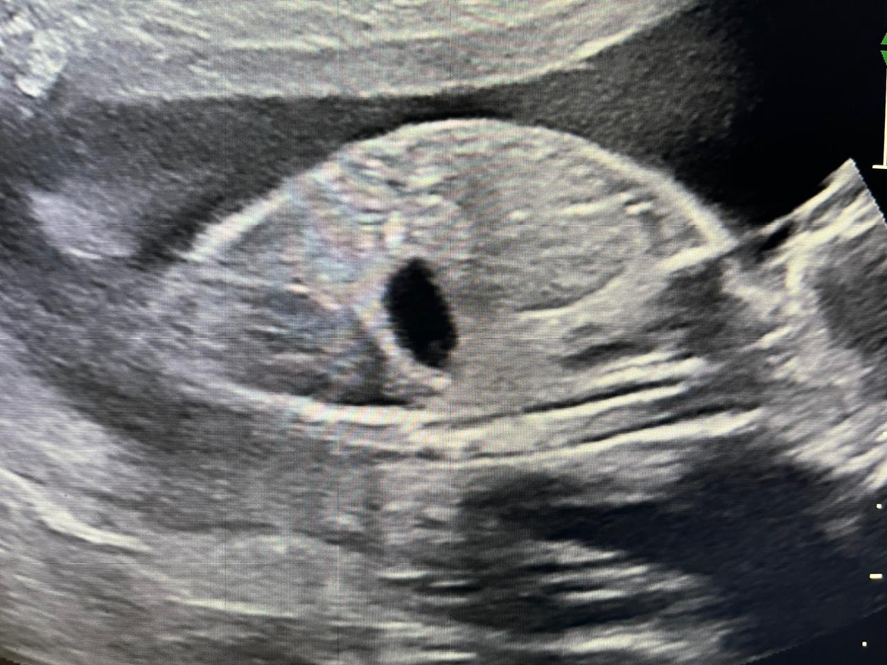 Ultrasound at 22 weeks showing diaphragmatic eventration / hernia