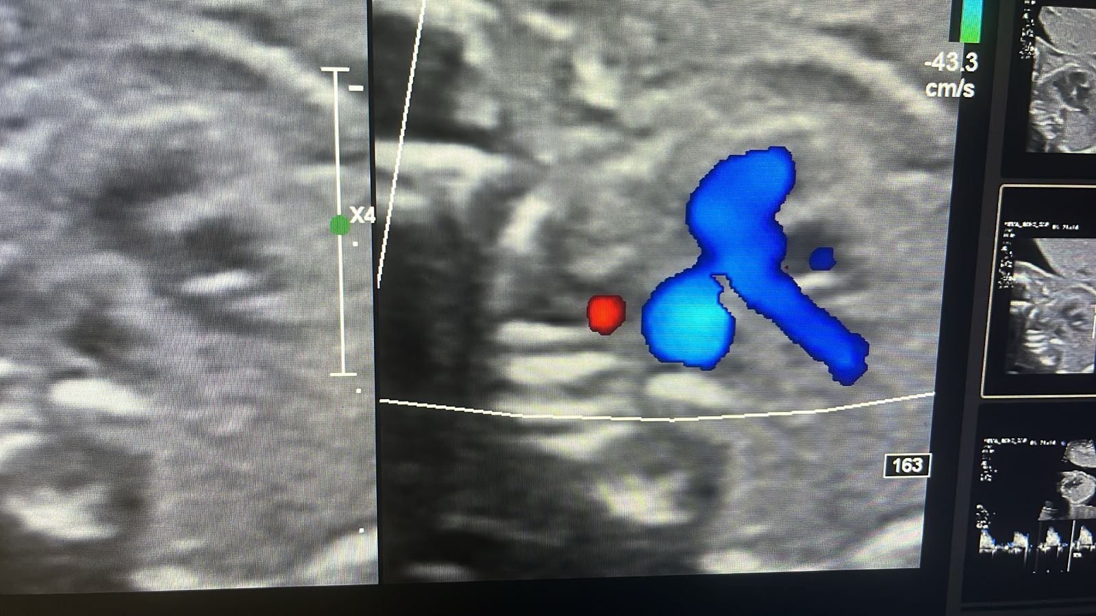 Horseshoe kidney on colour Doppler at 21 weeks