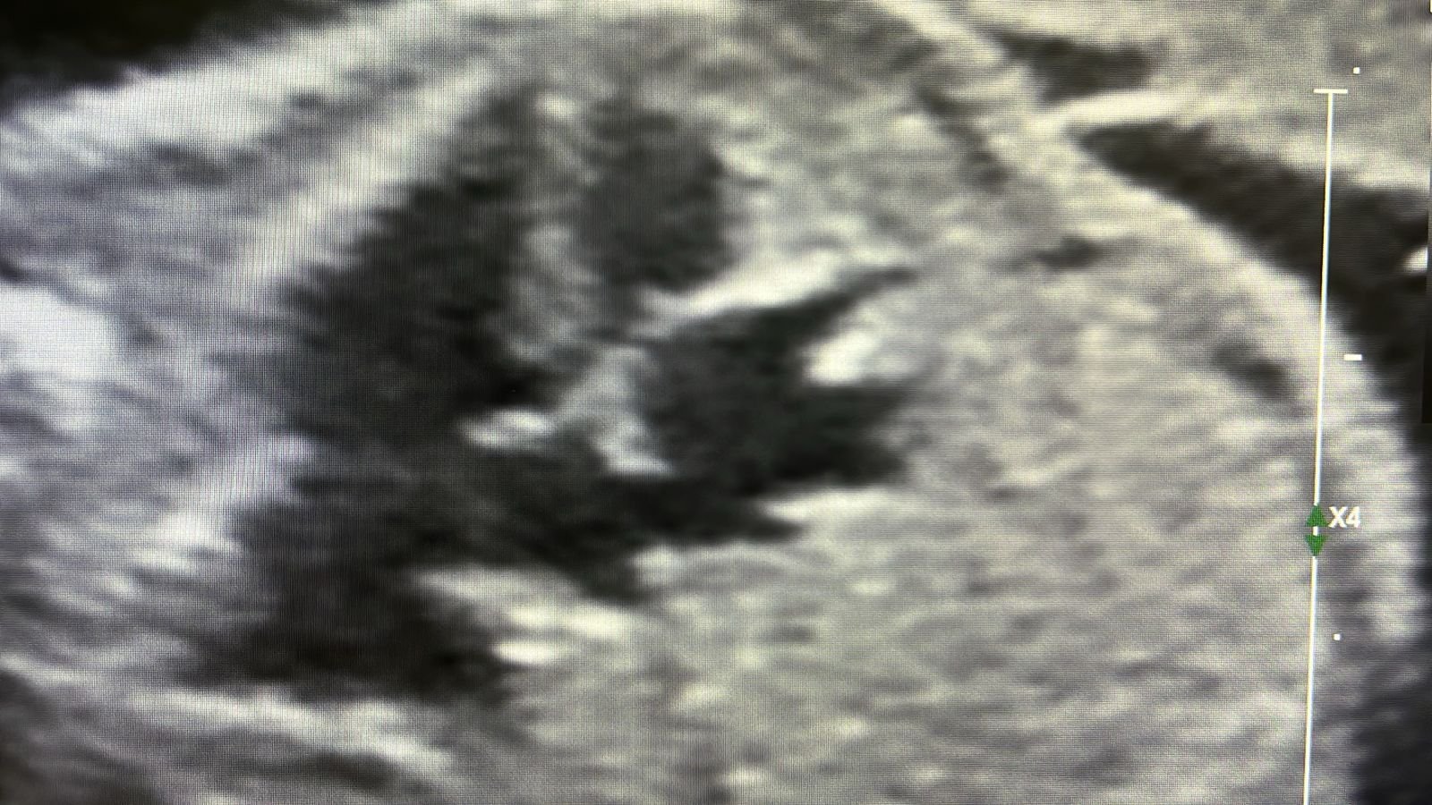 Horseshoe kidney sagittal view at 21 weeks
