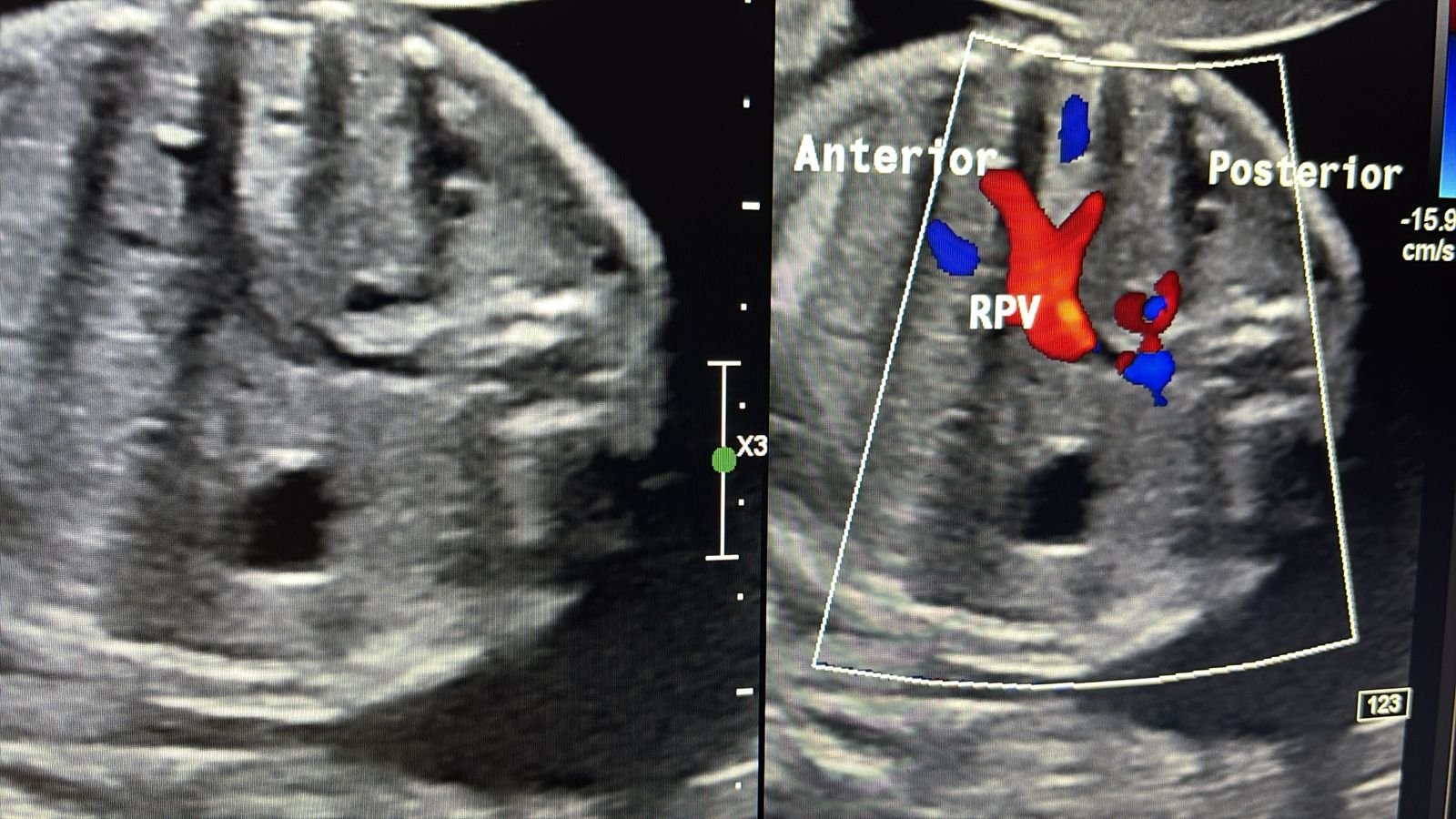 Colour Doppler showing normal fetal portal venous system — LPV and UV